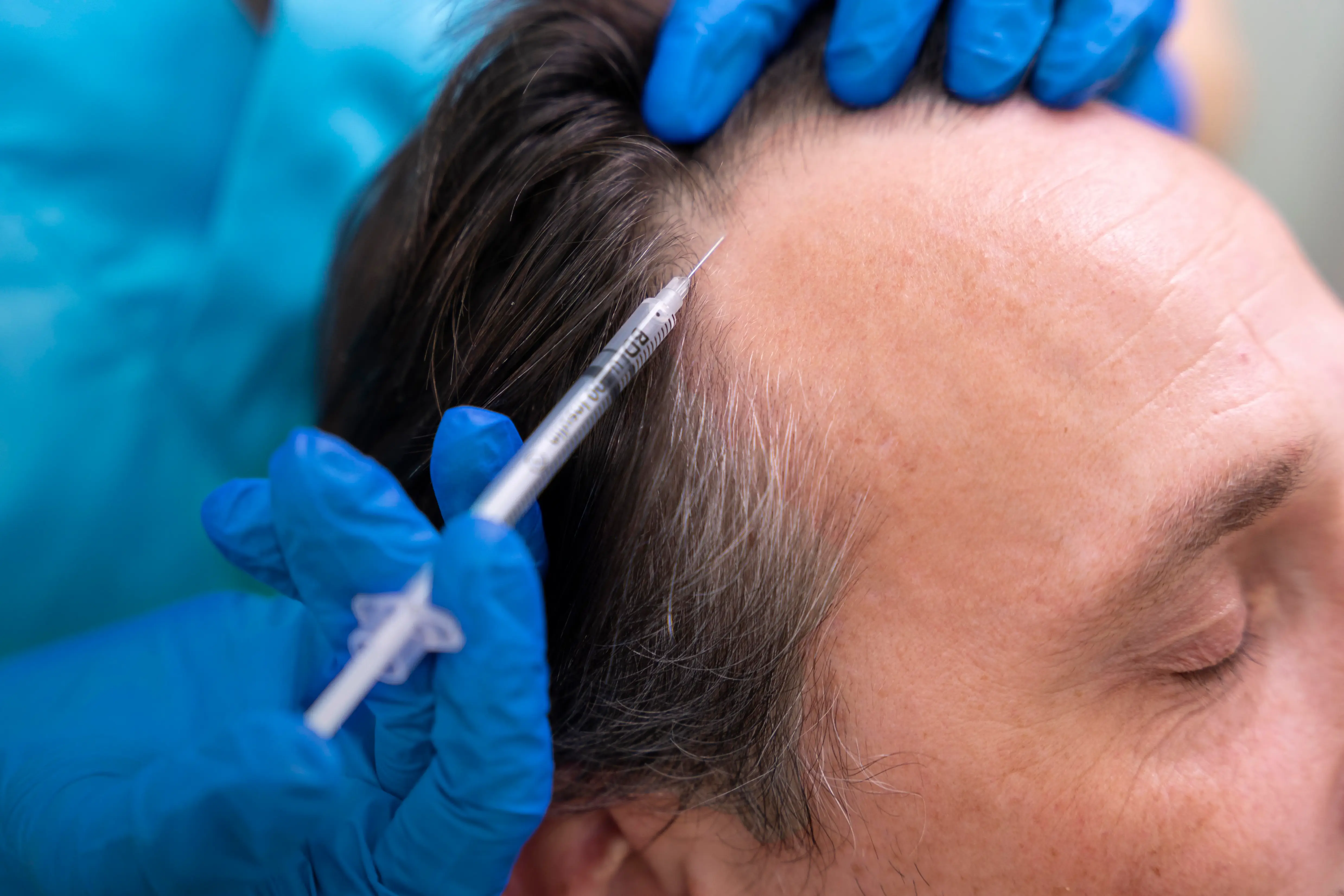Mesotherapy for Hair Loss
